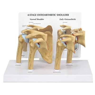 Image of 3B Scientific 4 Stage Osteoarthritis (OA) Shoulder Model