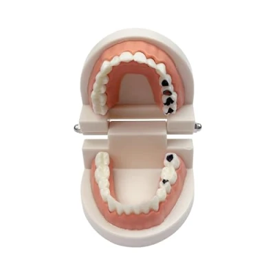 Image of Decay Tooth Model, YOUYA Dental Caries Standard Teeth Teaching Model Study Tool Adult Disease Typodont Demonstration for Kids Oral Care