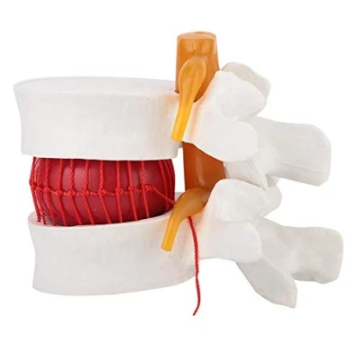 Image of Human Lumbar Model Skeleton Spine Model,1:1.5 Demonstration of Vertebral Disc Herniation