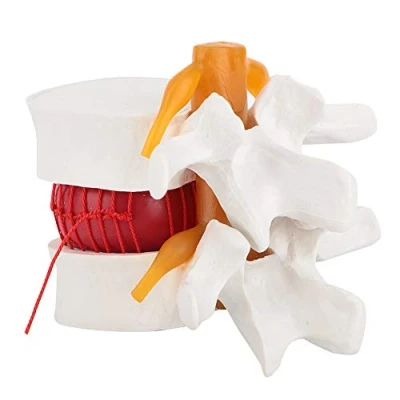 Image of Human Anatomy, 1:1.5 Lumbar Disc Herniation Demonstration Model of Vertebral Spine for Medical