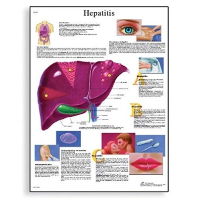 Image of 3B Scientific Human Anatomy Hepatitis Chart, Paper Version