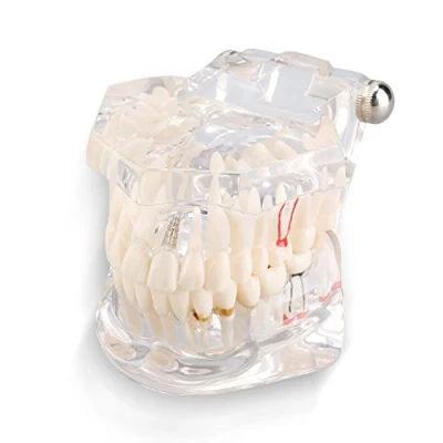 Image of Teeth Model, Transparent Dental Implantation Disease Tooth Model Teaching Study Adult Demonstration Models Anatomical for or Oral Care