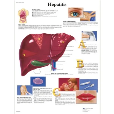 Image of 3B Scientific Human Anatomy Hepatitis Chart, Laminated Version