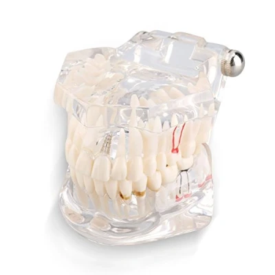 Image of Yosoo Transparent Adult Pathologies Dental Dentist Implant Demonstration Periodontal Disease Assort Teeth Gums Tooth Care Teaching Study Standard Typodont Model Removable (1 Pcs)
