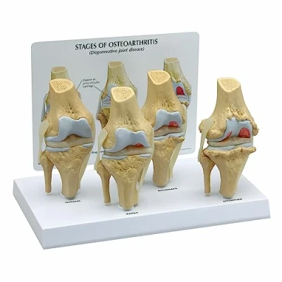Image of 3B Scientific 4 Stage Osteo Knee Model Set