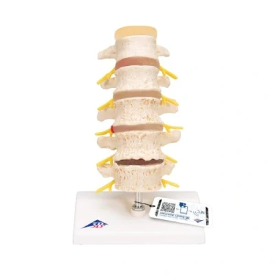 Image of 3B Scientific Stages of Disc prolapse and Vertebral Degeneration + free Anatomy App Smart A795