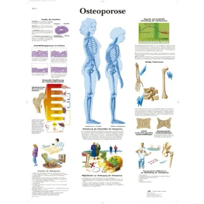 Image of 3B Scientific Chart Laminated Osteoporosis, 1