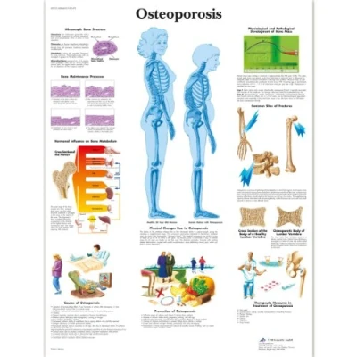 Image of 3B Scientific Human Anatomy Osteoporosis Chart, Laminated Version