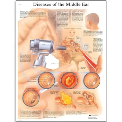 Image of 3B Scientific Human Anatomy Diseases of the Middle Ear Chart, Paper Version
