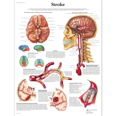 Image of 3B Scientific Human Anatomy Stroke Chart, Laminated Version