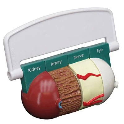 Image of 3B Scientific 4 Piece Diabetes Model